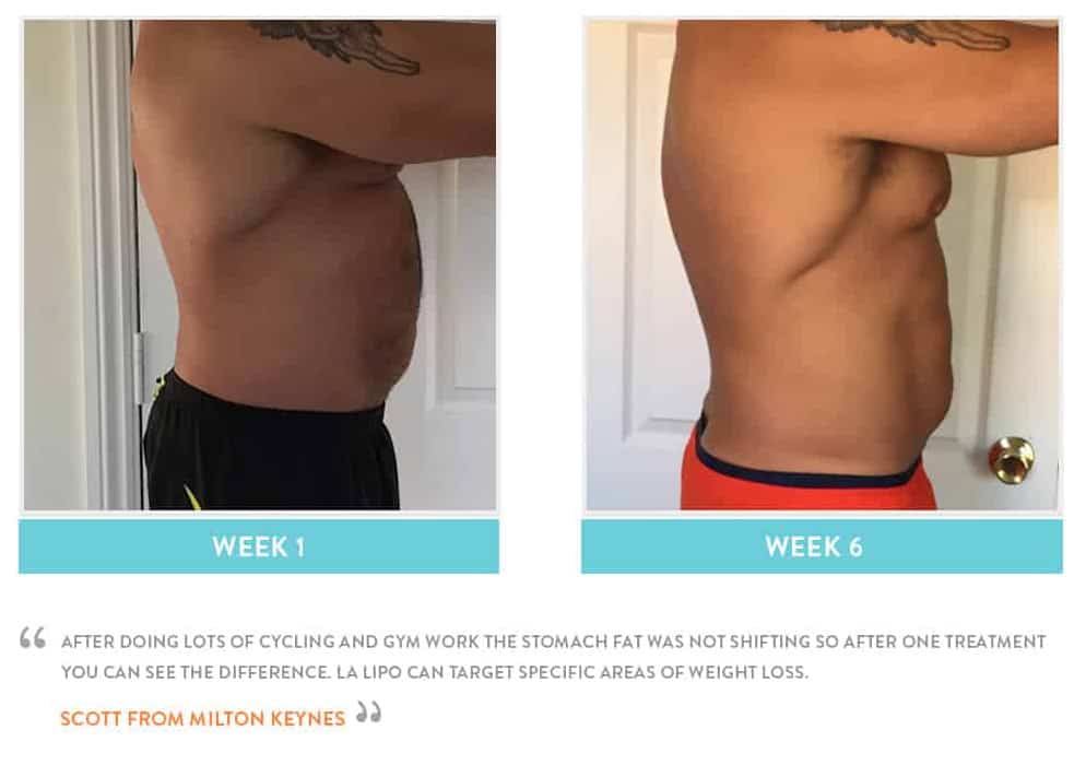 Before & After Stomach Fat Warrington