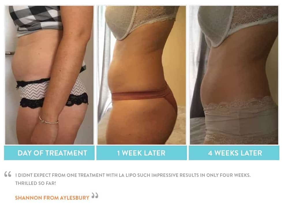 before, Cryolipolysis Warrington