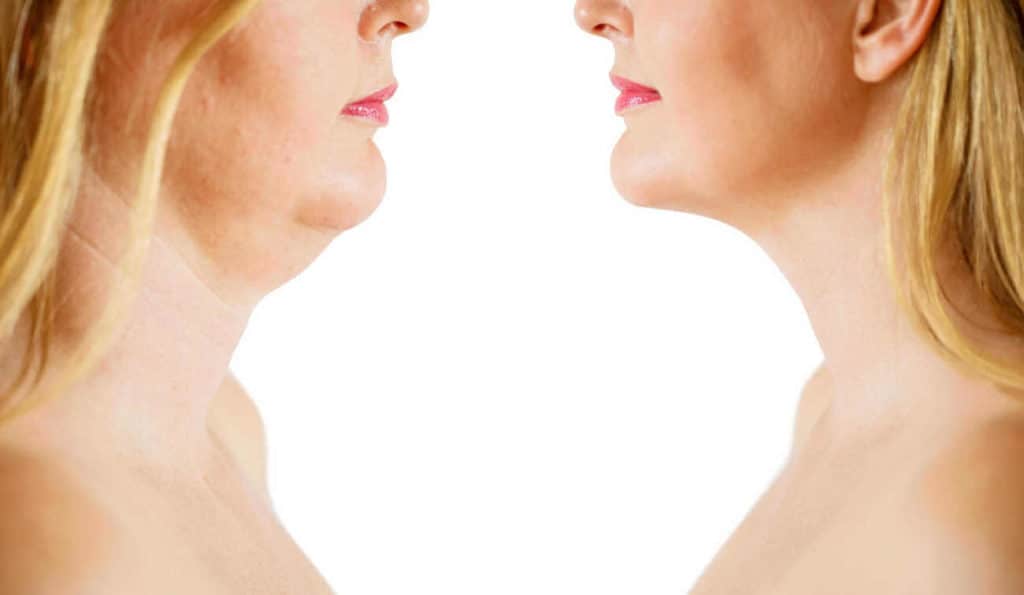 Double Chin treatment Warrington before and after results