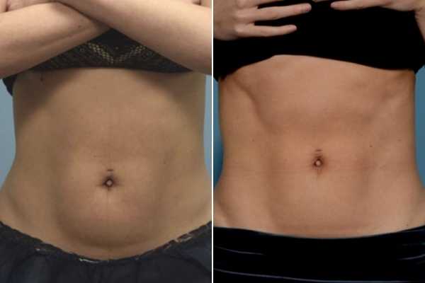 body sculpting FAQs Warrington