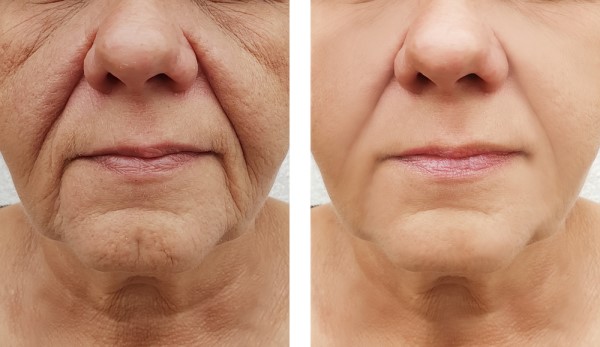 Learn more about Morpheus8 Treatment Warrington today!