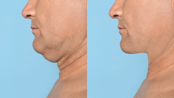 Which Non-Surgical Treatments Work Best for Jowls and Loose Skin Warrington?