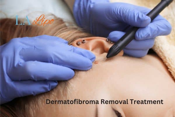 Dermatofibroma Removal Treatment Warrington
