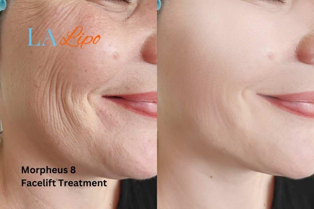 Morpheus8 Treatment Warrington for flawless skin! Call us today!