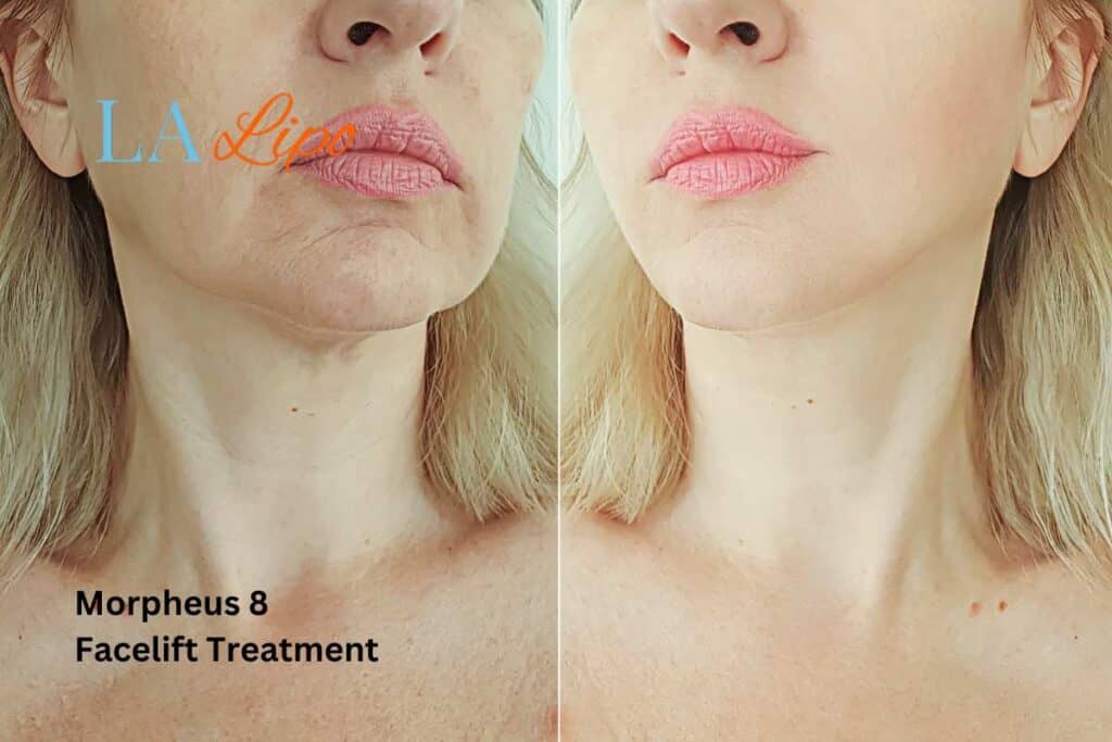 Turn back time with Morpheus8 Treatment Warrington