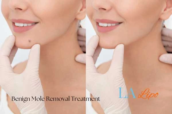 woman's before and after mole removal Warrington results