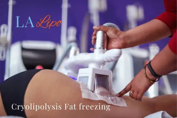women getting fat freezing Warrington