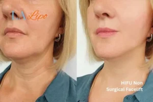 hi-fu for wrinkles Warrington before and after results