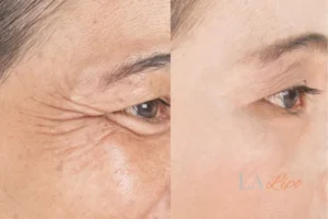 Before and after results of woman - HI-fu wrinkles reduction treatment Warrington