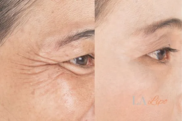 Before and after results of woman - HI-fu wrinkles reduction treatment Warrington