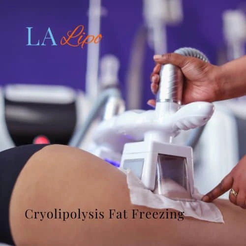 fat freezing - Cryolipolysis Warrington