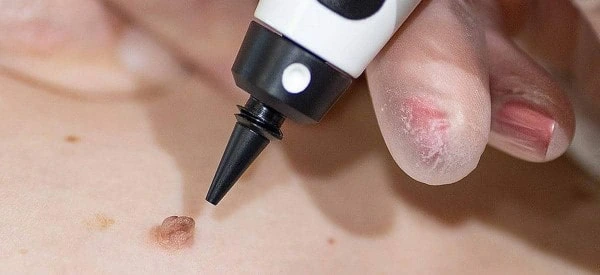 skin tag removal using cryopen Warrington