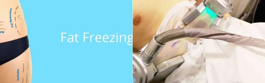 Fat freezing Warrington on multiple areas of the body