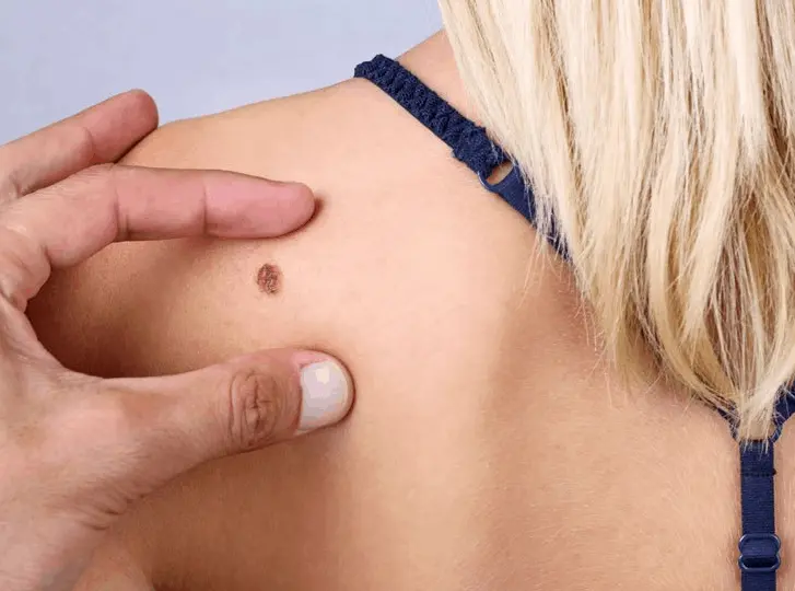 woman having mole removal Warrington consultation before treatment.