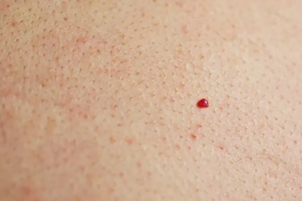 close up of a cherry angioma Warrington