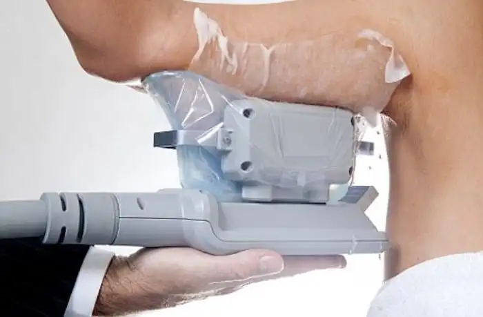 Picture of fat freezing Warrington on the upper arms.