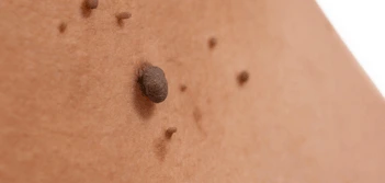 image of a skin tag Warrington