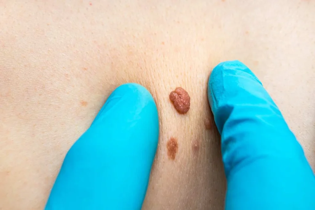 Consultant examining a skin tag Warrington