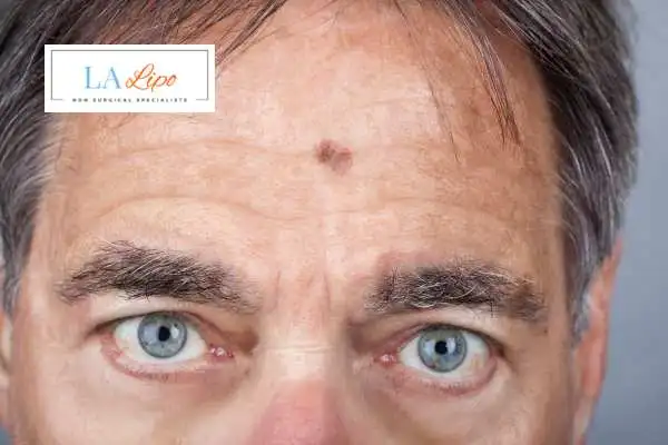 Solar Lentigo Removal Warrington image of man with mark on his forehead