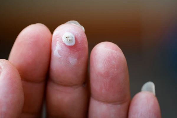wart on person finger - cryotherapy to treat from LA LIPO Warrington