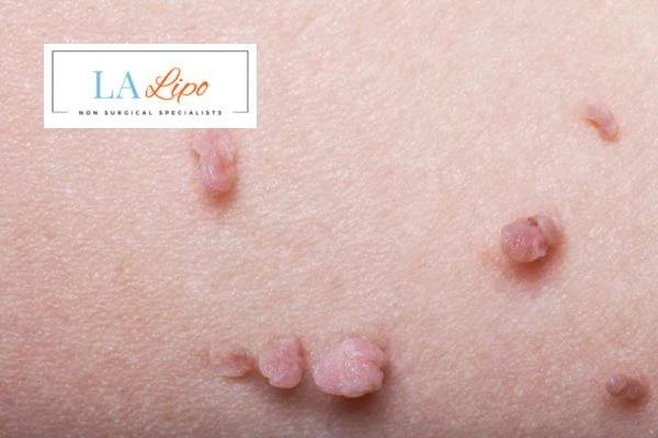 Does cryopen skin tag removal Warrington hurt? Find out now call our team today!