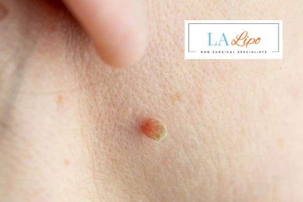 Book skin tag removal Warrington today speak to our team now!
