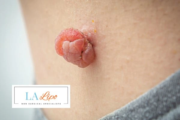 Interested in skin tag removal Warrington? Concerned about the pain? Find out more today!