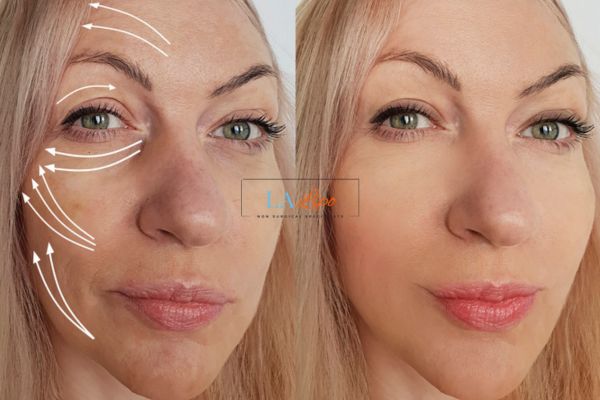 Morpheus 8 results Warrington face lift.