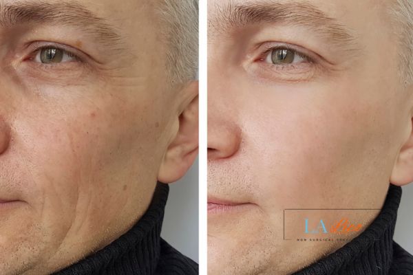 See the amazing results of Morpheus8 Treatment Warrington!