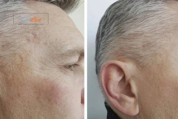 Mens Before & After Morpheus 8 Results Warrington