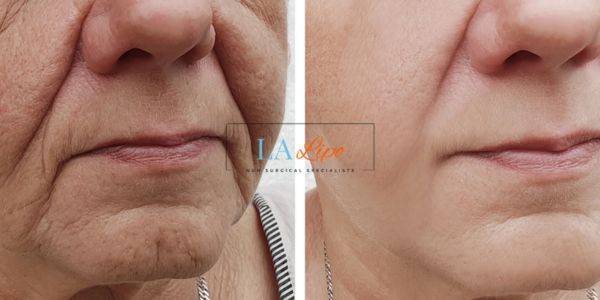 Older lady deeper wrinkle reduction - LA LIPO Morpheus 8 Results Warrington