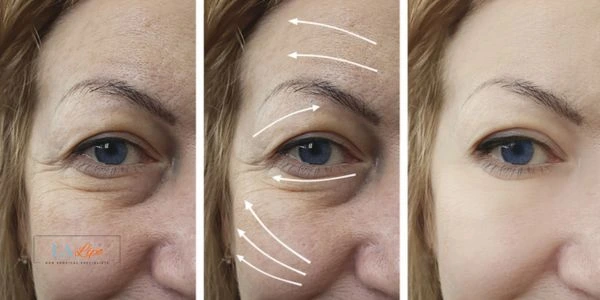 Amazing eye lift Morpheus 8 results Warrington