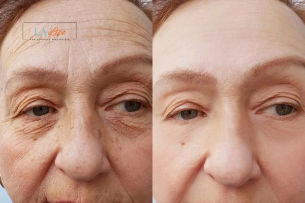 The powerful benefits of Morpheus8 Treatment Warrington - Call Our team today!