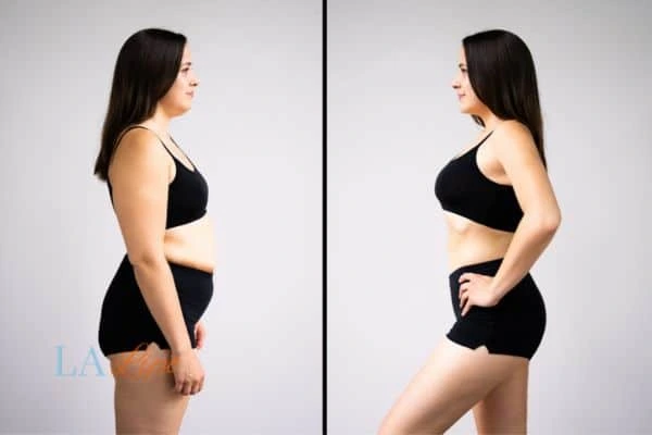 Picture of womans before and after using LA-EMS body sculpting to improve her core strength Warrington