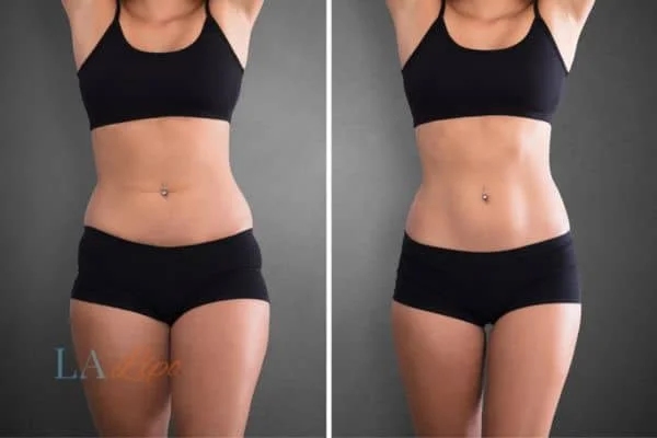 before and after results of non-surgical treatment to help a woman's body image and mental health Warrington