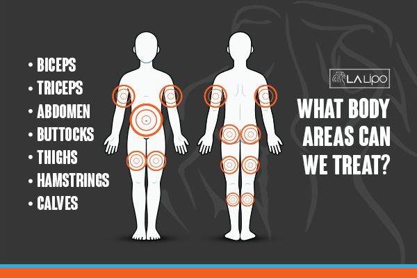 Diagram to show areas you can have LA-EMS Body Sculpting Treatment Warrington