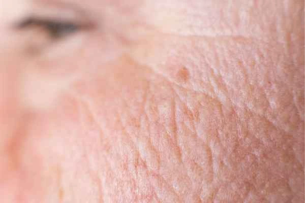 close up picture of a woman's face showing an age spot Warrington