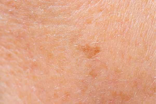 close up picture of age spots Warrington