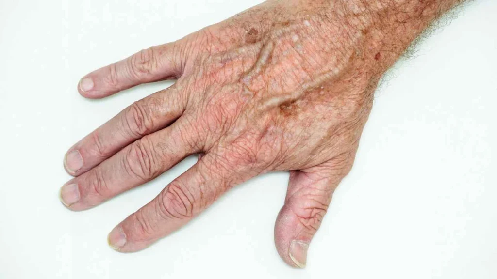 Male hand showing age spot Warrington