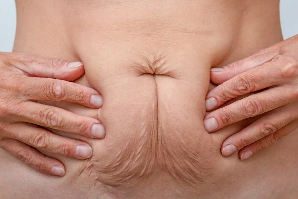 Should I Combine Diastasis Recti Treatment with Body Contouring for Better Results Warrington?