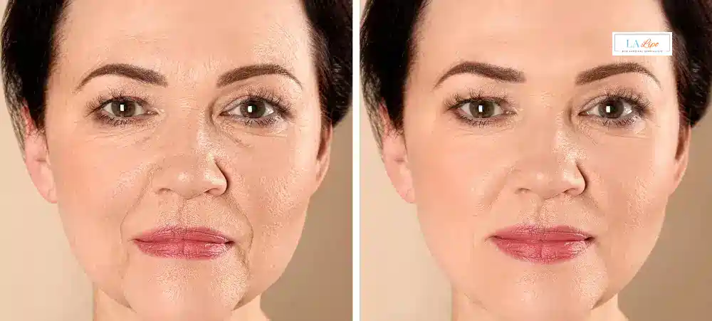 How Long Does It Take to See Results and How Long Do They Last Warrington?