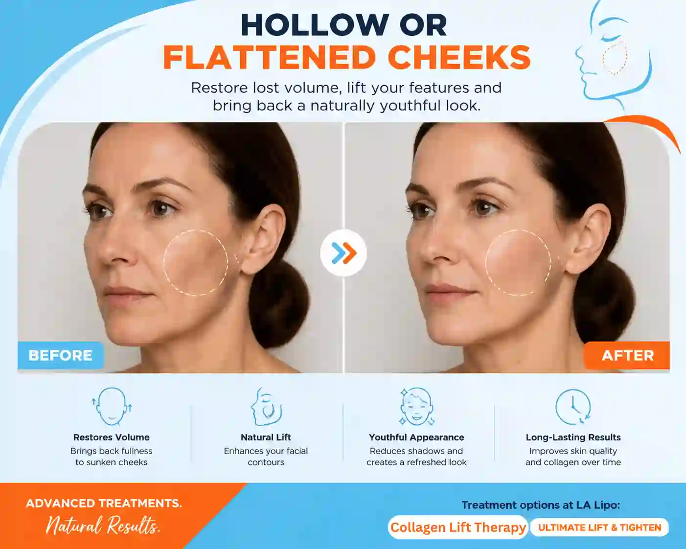Sign #4: Hollow or Flattened Cheeks Warrington
