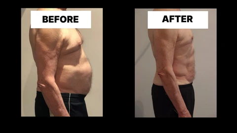 What Symptoms Can Diastasis Recti Cause in Men? Weak Core, Back Pain and Poor Posture Warrington